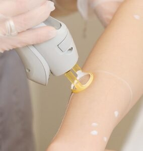 Эпиляция рук лазером: эффективное решение для гладкой кожи