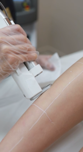 Топ ошибок после лазерной эпиляции: как избежать раздражения и нежелательных реакций